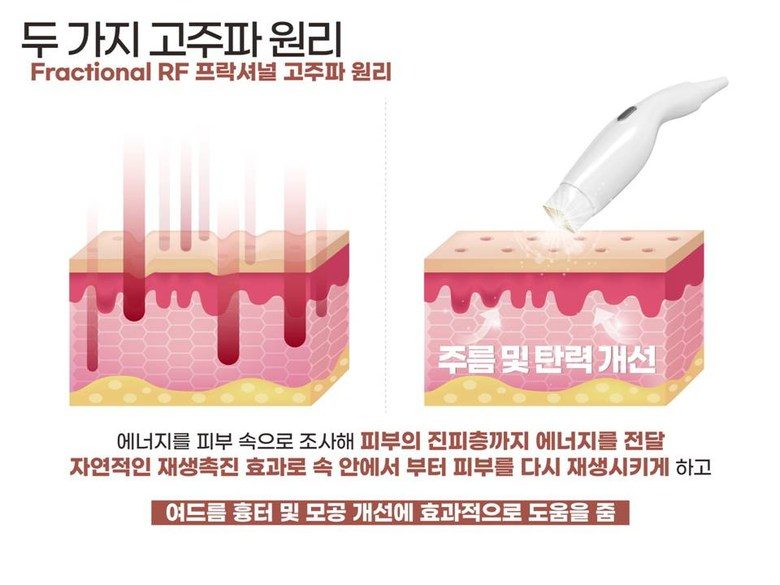 폴카 RF 피부관리 기기 프락셀 고주파 프락셔널 피부 관리기 프락셀 피부재생 콜라겐생성 리프팅 노화 눈가주름 - 한국